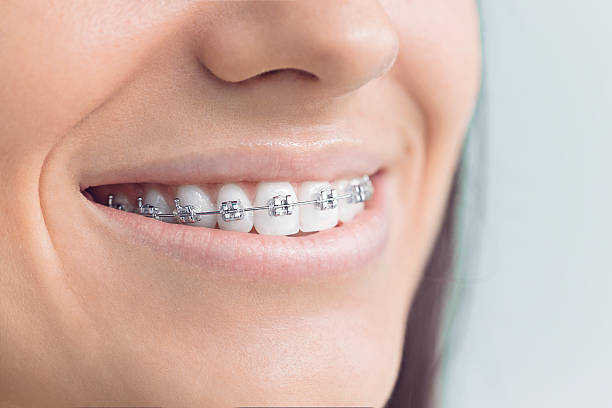 Best Veneers and Lumineers  in Wye, MT